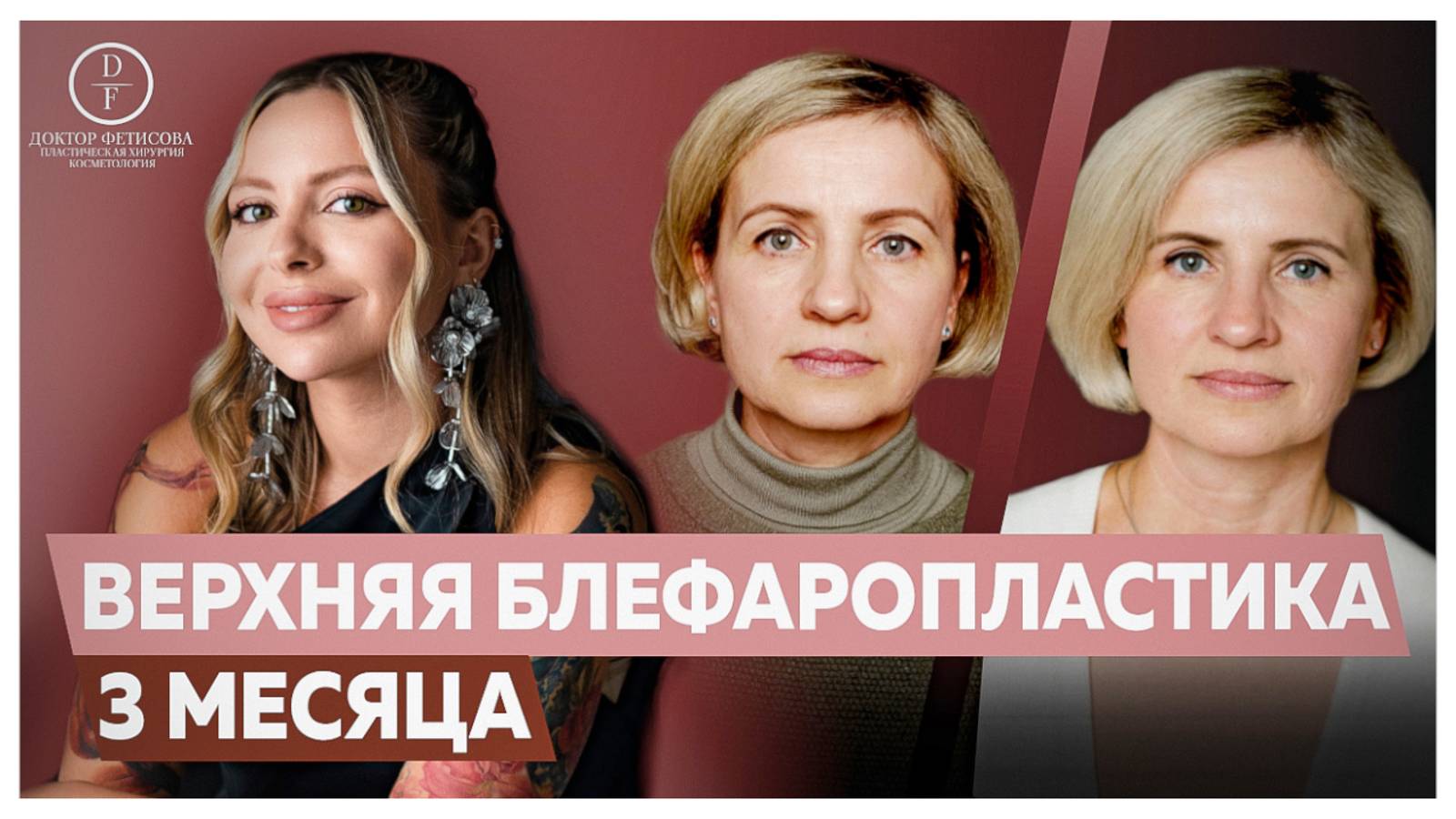 ВЕРХНЯЯ БЛЕФАРОПЛАСТИКА: 3 МЕСЯЦА