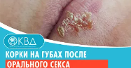 ? Корки на губах после орального секса. Клинический случай №665