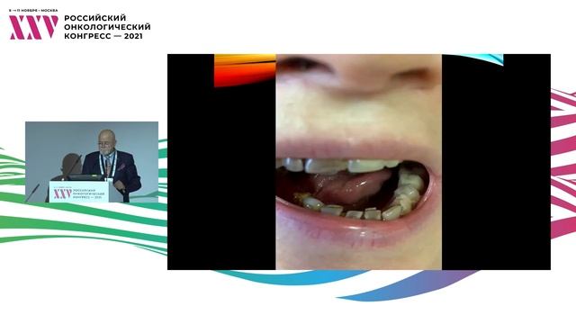 Рак слизистой оболочки полости рта. Гемиглоссэктомия. Применение лоскута на передних длинных мышцах смотреть онлайн