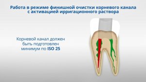 Подготовка корневого канала эндо файлами. Компоцем-Эндо-браш