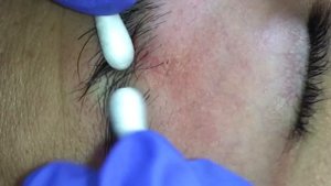 Cyst Extraction on Eyebrow
