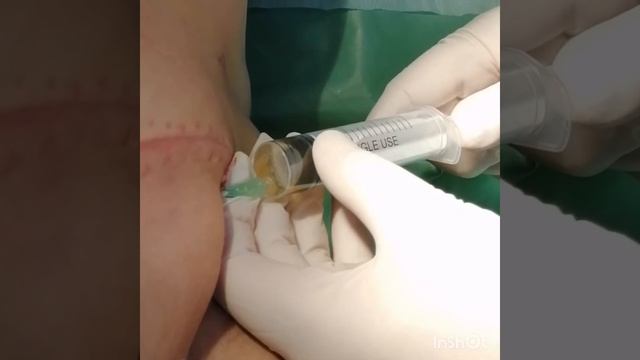 Эвакуация серомы после мастэктомии