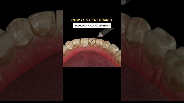 #dental #treatment dental scaling and polishing