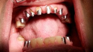 4- стоматология. Металлокерамические протезы к 8 марта. Дневник стоматолога.