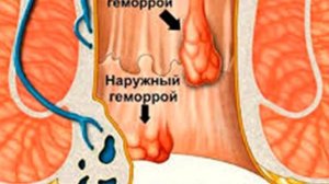 Пять рецептов от геморроя и один от трещины прямой кишки