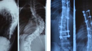 Хирургическое лечение сколиоза 4 степени | Отзывы о лечении сколиоза