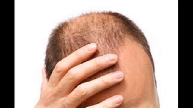 Как лечить и Cure Облысение смотреть онлайн