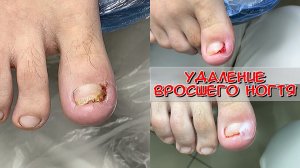 Удаление вросшего ногтя