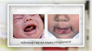 Пластика уздечки языка и губ с использованием лазера