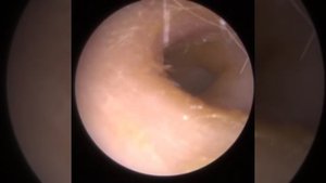 806 - Fungal Spores Ear Wax Removal Technical Challenge Collapsed Ear