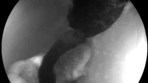 Язвенная ниша (рентгеноскопия желудка)