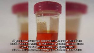 Кровь в анализе мочи