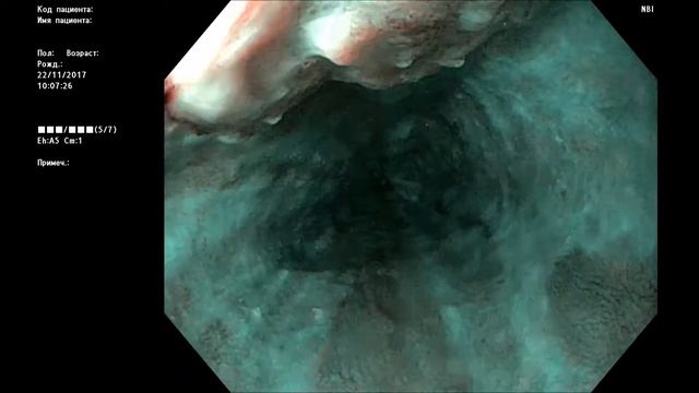 Рак пищевода м 1963 г р смотреть онлайн