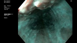 Рак пищевода м  1963 г р