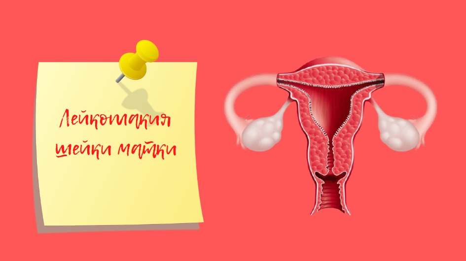 Лейкоплакия шейки матки | Как лечить
