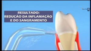 IRRIGADOR ORAL DENTAL CLEAN - DENTES PERFEITOS STORE