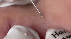 Чистка пор и выдавливание прыщей