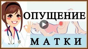 ОПУЩЕНИЕ МАТКИ