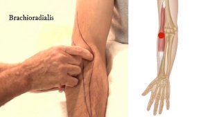How To Treat Trigger Points - Brachioradialis
