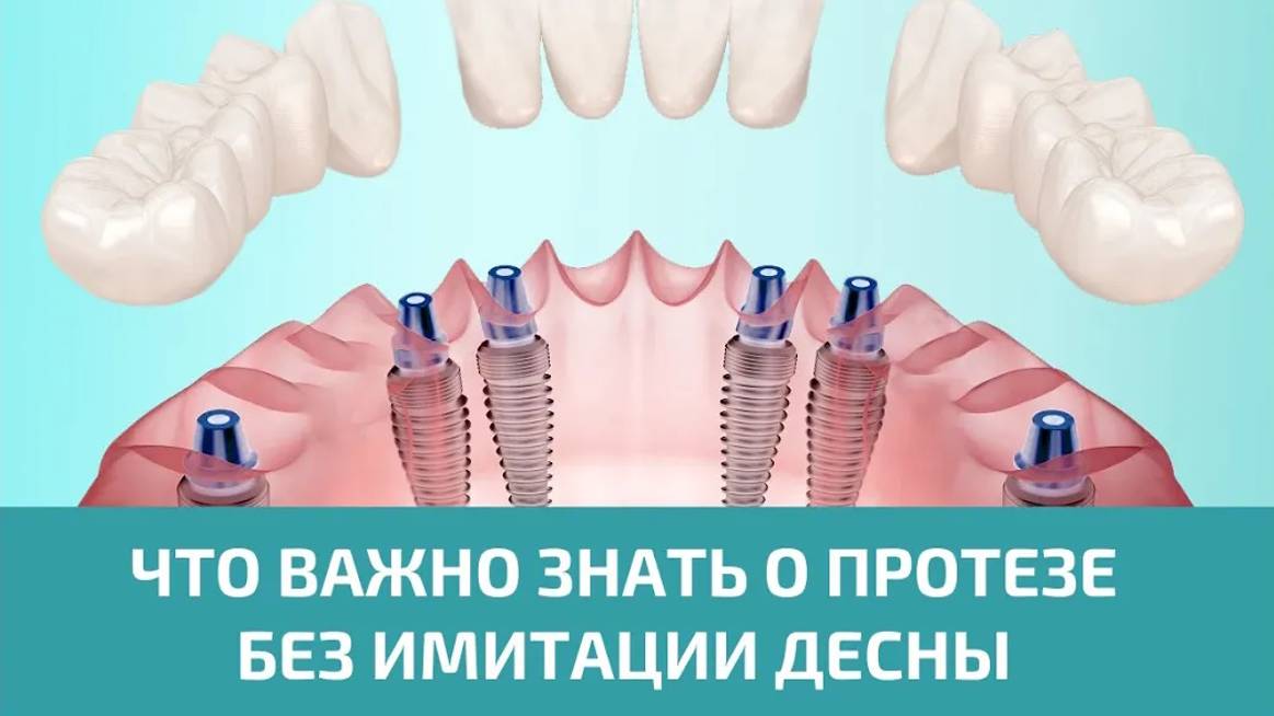 Протезирование на имплантах без имитации десны