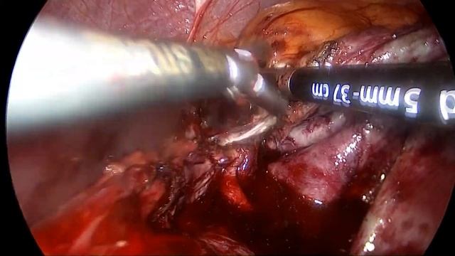Дзитиев Виталий Казиханович Непростая киста почки смотреть онлайн