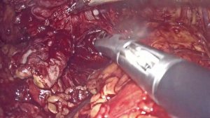 простатэктомия после TAPP // laparoscopic prostatectomy after previous TAPP hernia repair