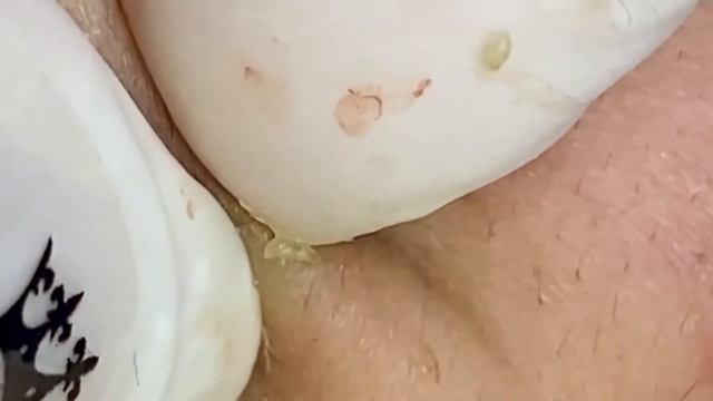 How to get rid of blackheads ,blackhead extraction ,Успокаивающее расслабление