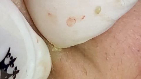 How to get rid of blackheads ,blackhead extraction ,Успокаивающее расслабление