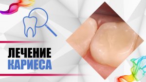 #Кариес - лечение зубов. Установка пломбы. Что делать, чтобы не возник пульпит?  [Лечение кариеса].