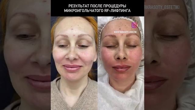 РЕЗУЛЬТАТ ПОСЛЕ ПРОЦЕДУРЫ МИКРОИГОЛЬЧАТОГО RF-лифтинга смотреть онлайн