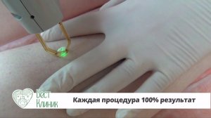Лазерное удаление сосудистых звездочек