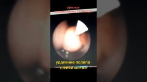 ПОЛИП ШЕЙКИ МАТКИ. УДАЛЕНИЕ.