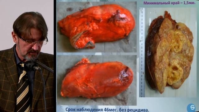 Проф. В.В. Тепляков, РНЦ Рентгенрадиологии «Современные возможности хирургического лечения».