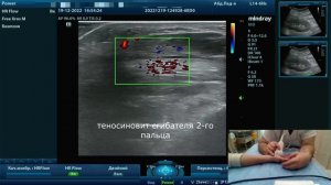 Ультразвуковое исследование (УЗИ) кистей при серонегативном артрите