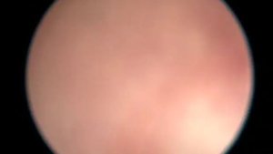 Urolithiasis + polyps in dog. Cystoscopy. Уролитиаз + полипы мочевого пузыря. Цистоскопия у собаки