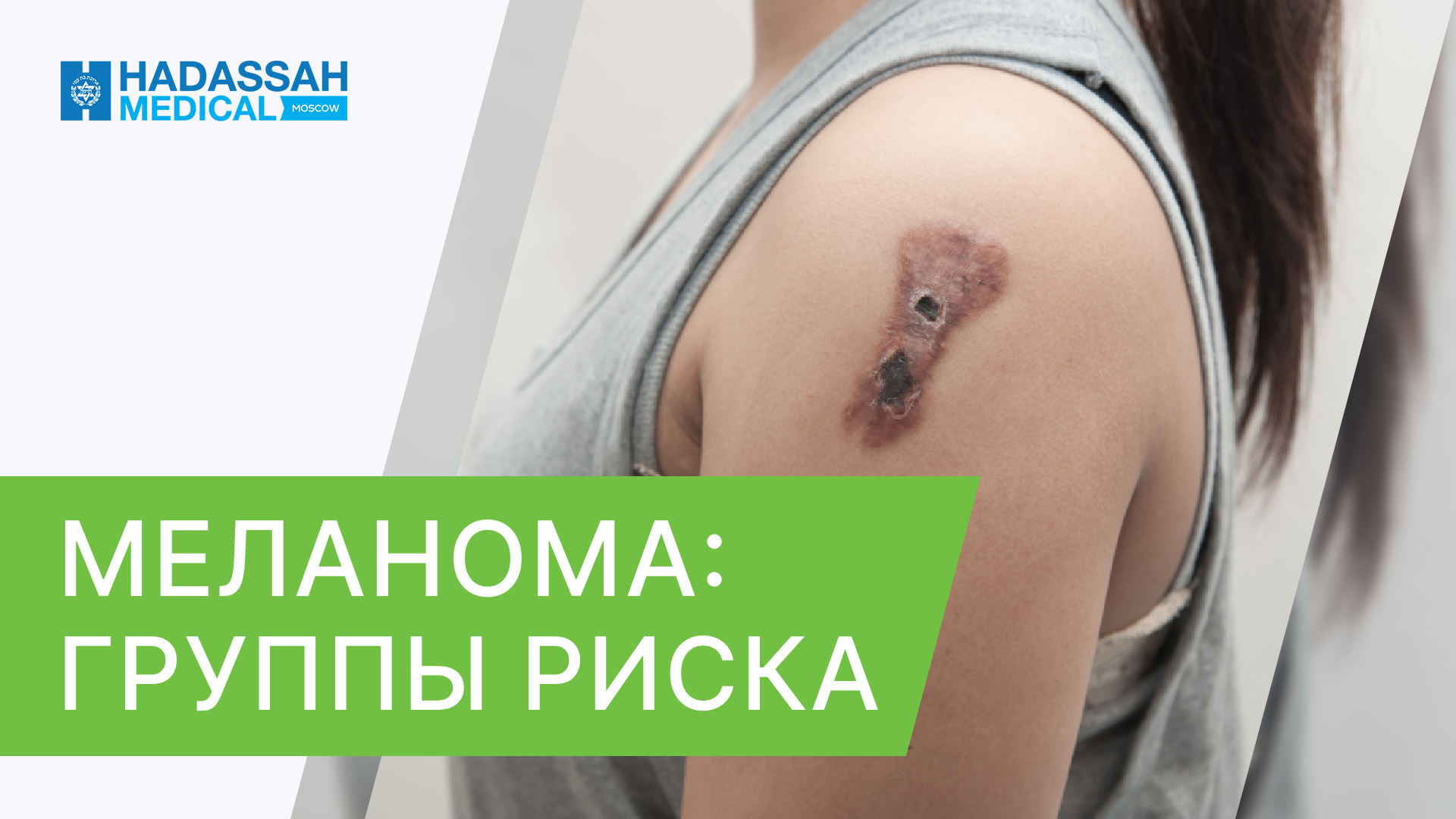⁉ Почему возникает меланома, и кто находится в группе риска? Меланома группа риска. 18+