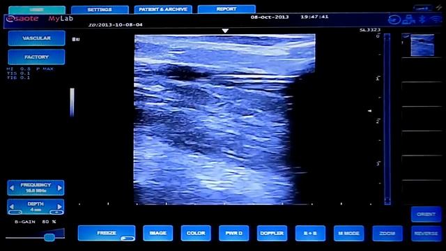 Радиочастотная облитерация вен смотреть онлайн