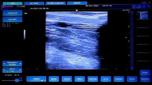 Радиочастотная облитерация вен