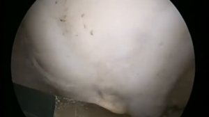 Холодно-плазменная санация краев дефекта хряща при хондромаляции 2 стадии медиального мыщелка бедра