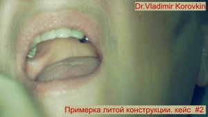 Примерка литого каркаса на имплантах 25 -27. Кейс #2.