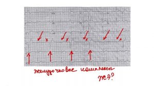 Парасистолия или желудочковые экстрасистолы? Анализ сложной ЭКГ.