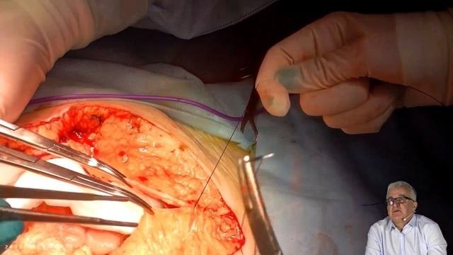 Техника ушивания продольной лапаротомии