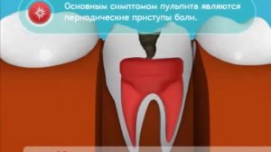 Пульпит -  Что  такое пульпит, как он образуется