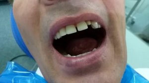 Фиксация на цемент керамический коронки на основе из диоксида циркония.