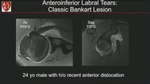 Stanford Radiology: "Glenoid Labrum: Location matters" by Michelle Nguyen, MD