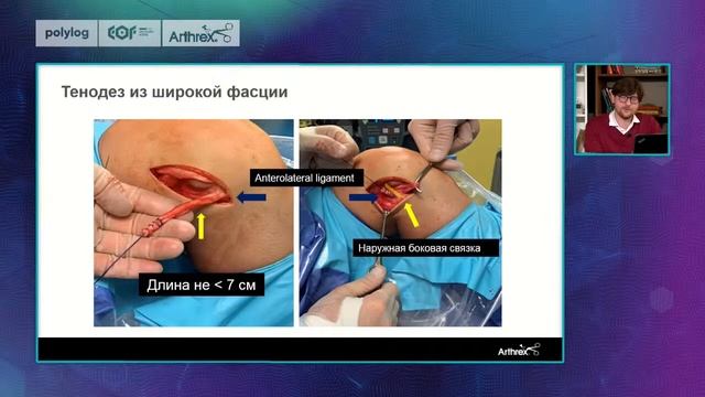 Лазишвили Гурам Давидович. Какова роль антеролатеральной связки в 2021 году? смотреть онлайн