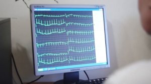 8 Велоэргометрия Тредмил тест