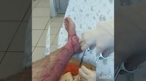 Последствия ожога, паром