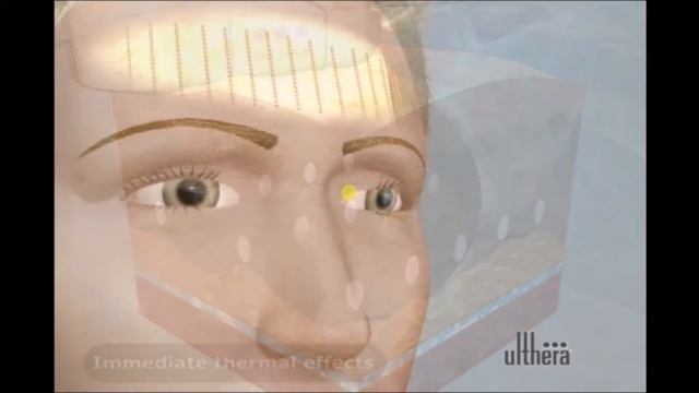 ulthera treatment Artvisage Balbriggan смотреть онлайн