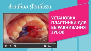 Установка пластинки для выравнивания зубов